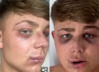 Ζάκυνθος: «Με έστειλαν στο νοσοκομείο για μία selfie», λέει ο Βρετανός τουρίστας που ξυλοκοπήθηκε από μπράβους